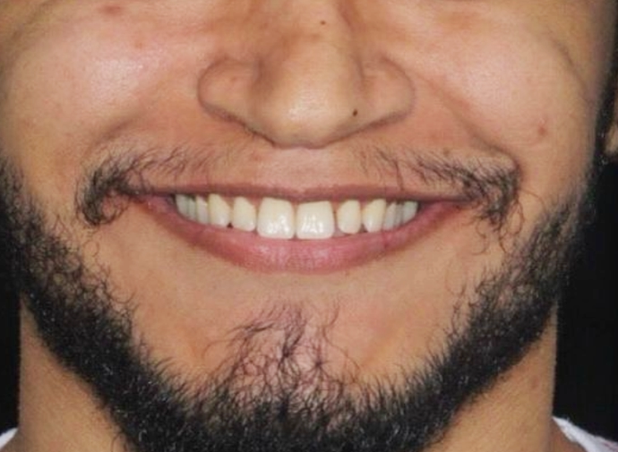 dentes_amarelados_antes