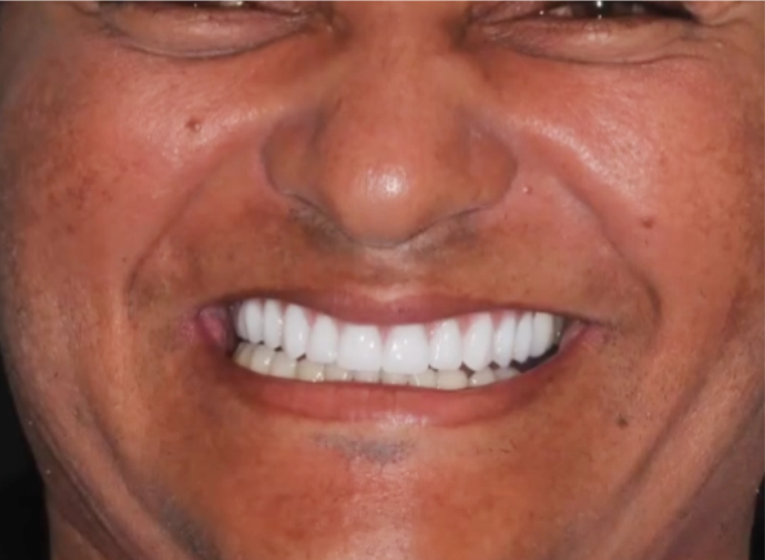 reabilitacao_dentario_depois